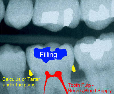 calculus xray color.jpg (29745 bytes)