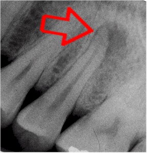 purple tooth xray2.jpg (27789 bytes)