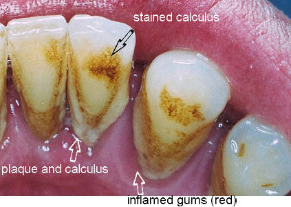 seattle dentist tartar 1