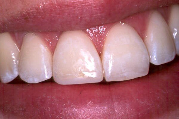 chipped tooth filling