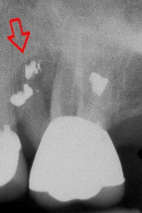 xray root resection 1.jpg (16604 bytes)